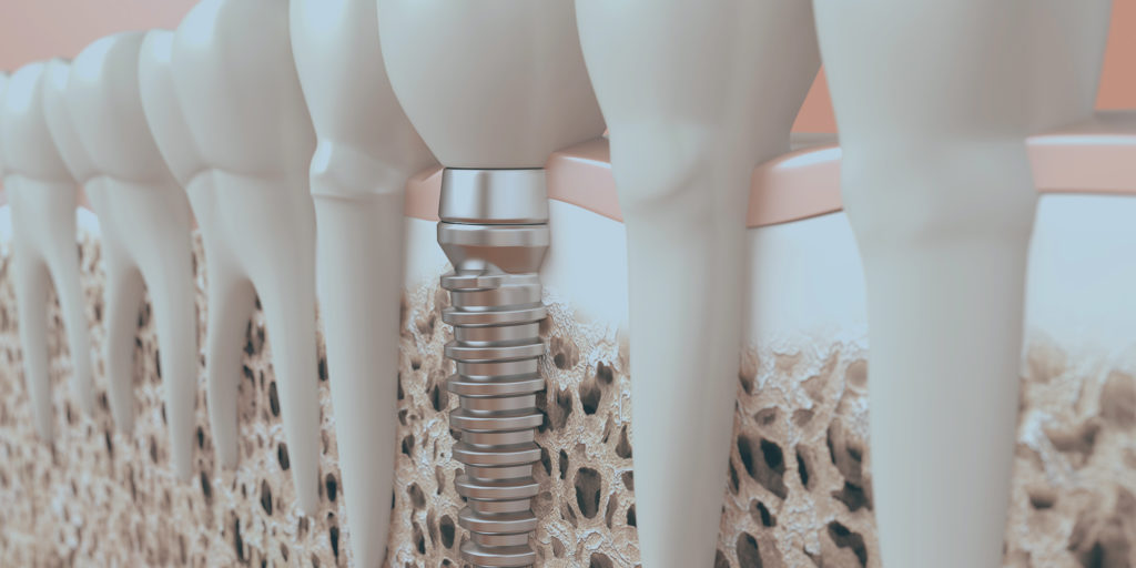 Bone grafting illustration Select Dental