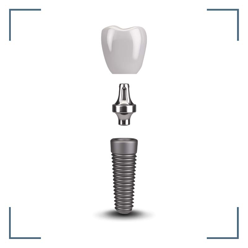 Dental Implant Select Dental