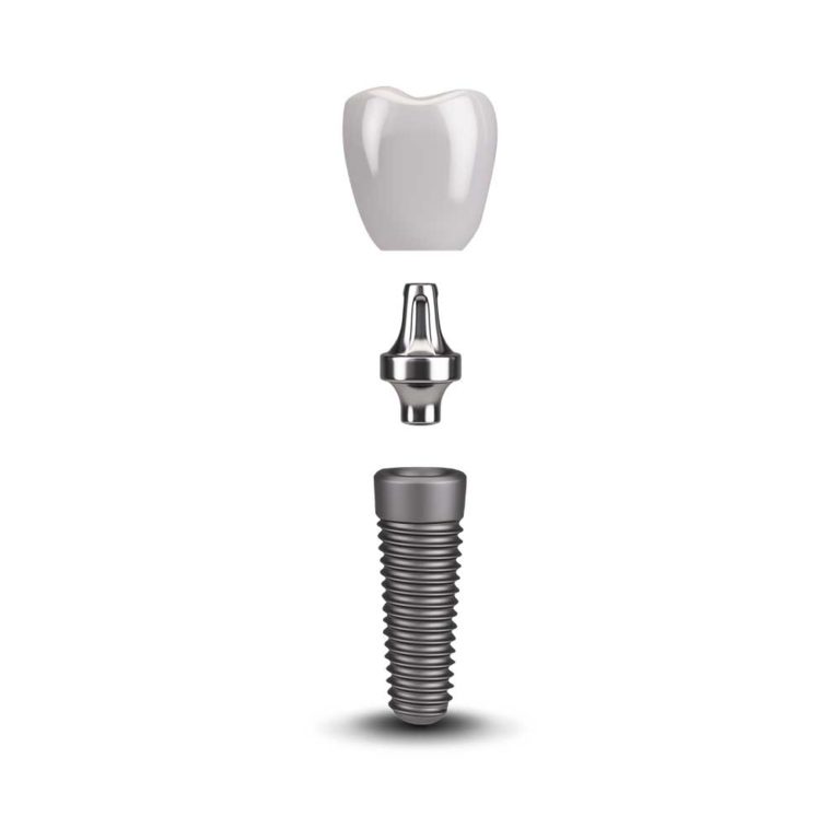 Dental implant model