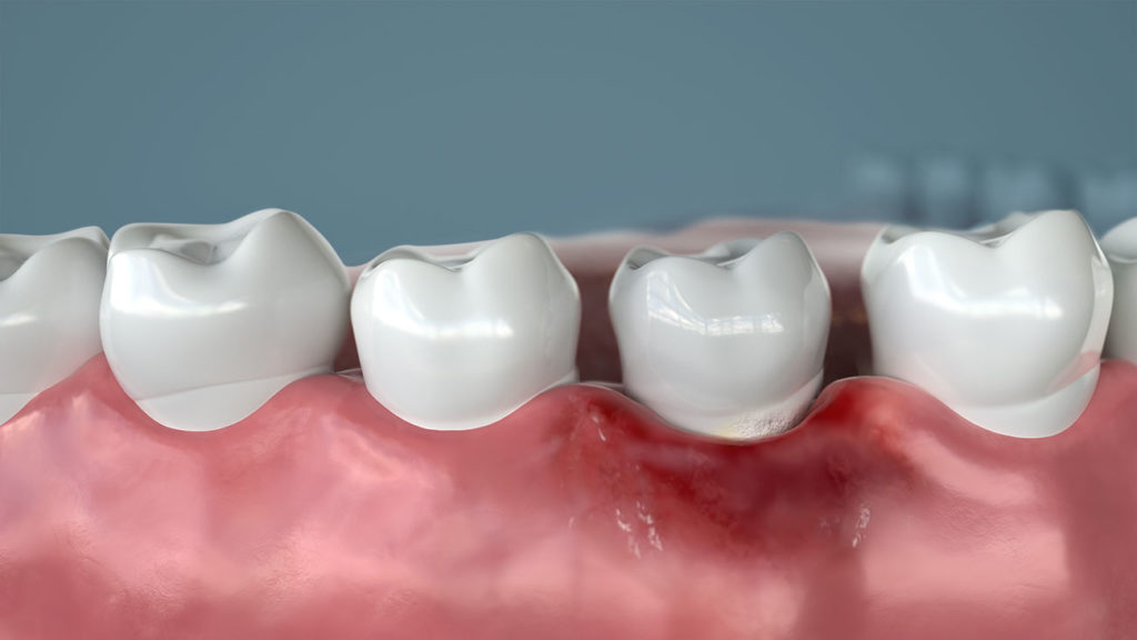gum disease Select Dental