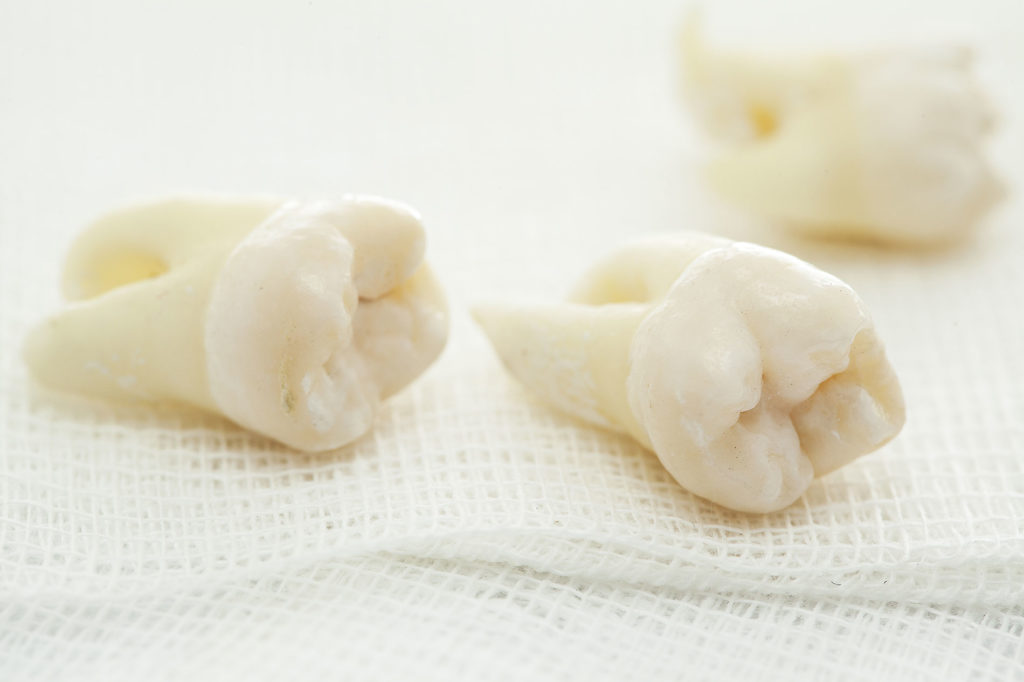 extracted teeth Select Dental