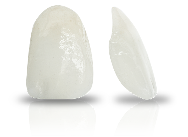 porcelain veneers Select Dental