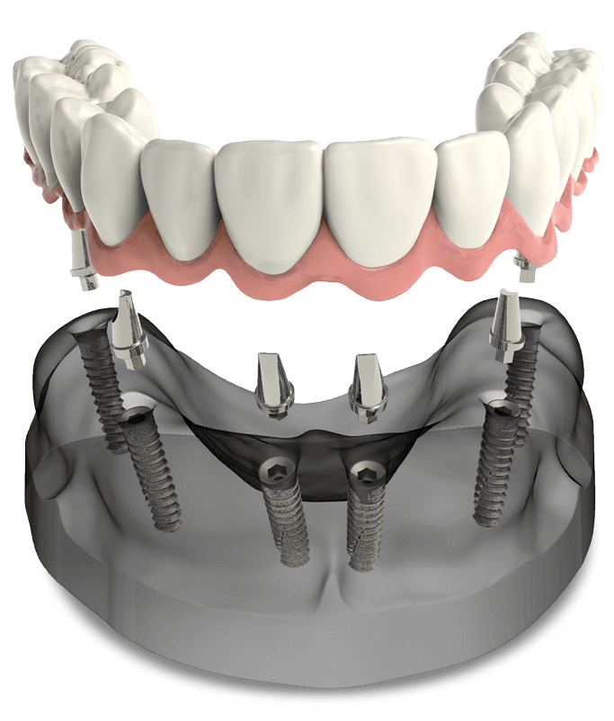 Full-arch dental implant model Select Dental