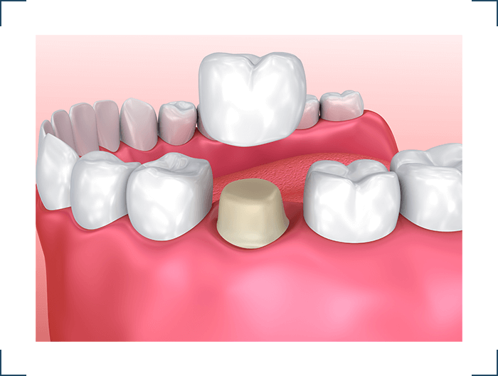 crown Select Dental